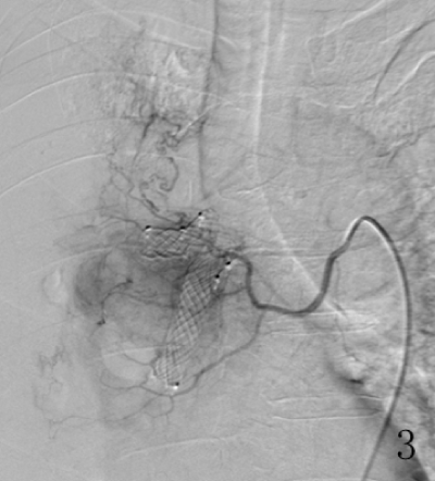  Right bronchial
