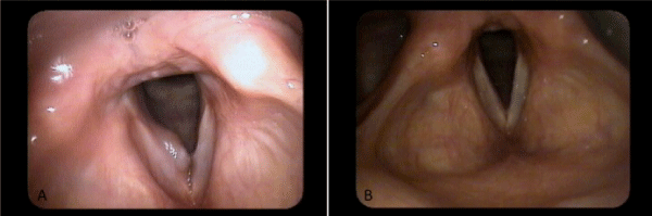 Videostroboscopy