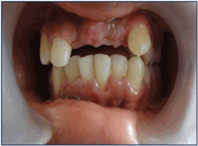 edentulous patients