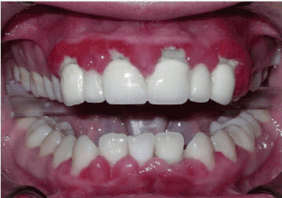 nifedipine induced gingival hyperplasia an overlooked adverse gingival hyperplasia