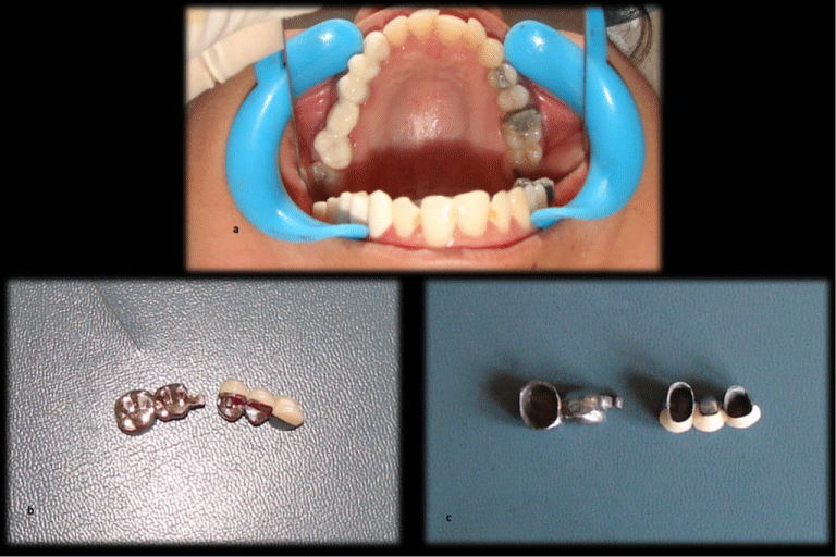 Effect of Non Rigid Connector on FPD with Pier Abutment A Case Report