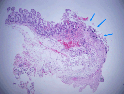 intestine