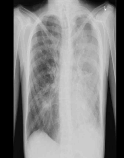 bronchogram