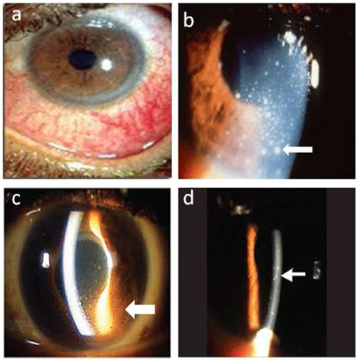 conjunctiva
