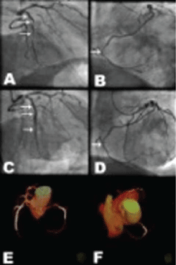Coronary