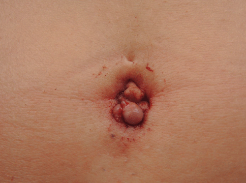 endometriosis