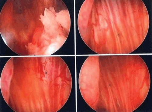 cystoscopy