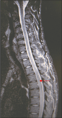 Subacute Progressive Ascending Myelopathy from L2 to C4 after A Burst