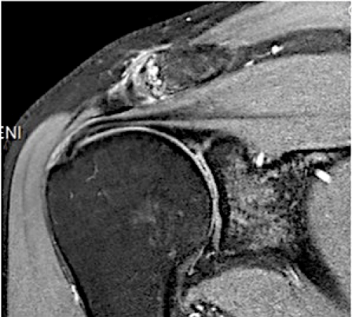 Dr Raymond Yu Adelaide Orthopaedic Surgeon Shoulder Specialist Best image Acromioclavicular Joint Arthritis 3 MRI of AC joint arthritis