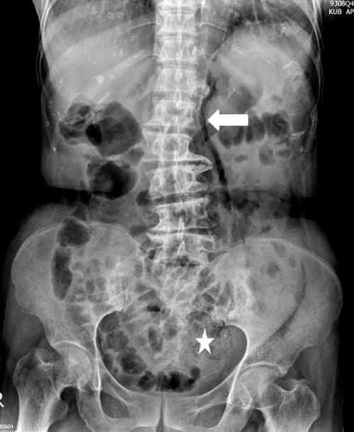 retroperitoneal