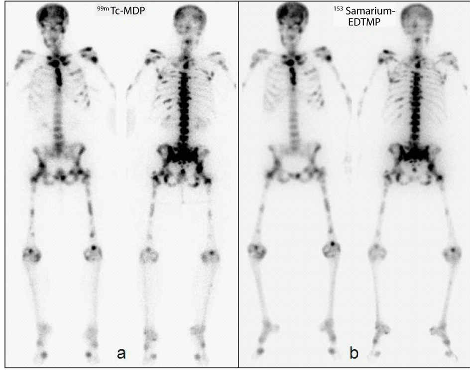 Superscan on both Bone Scans in a Patient with Breast Cancer OMICS International