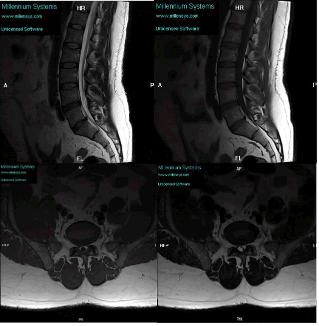 sagittal