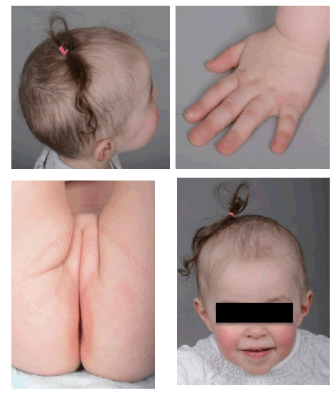 Acrodermatitis