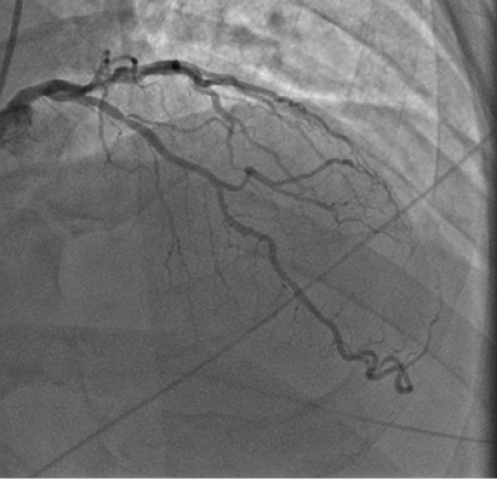 angiogram