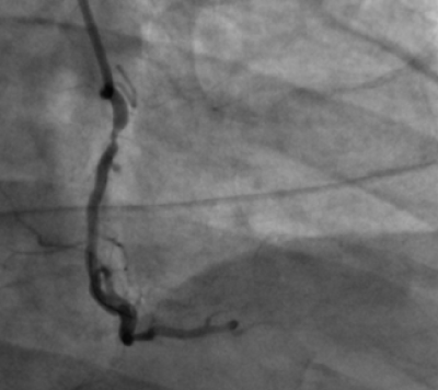 coronary