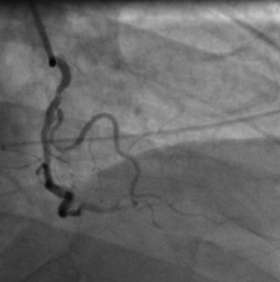 revascularization