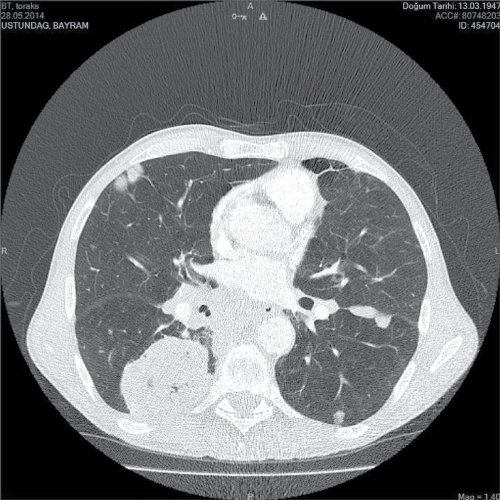 The nodular