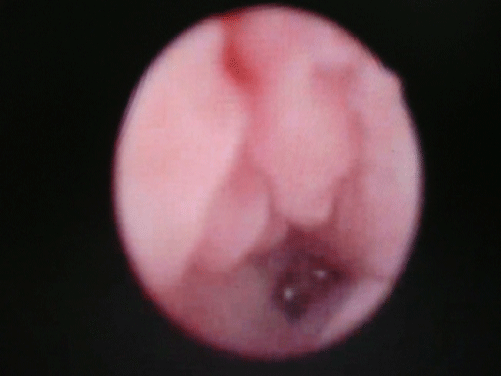 Bronchoscopic