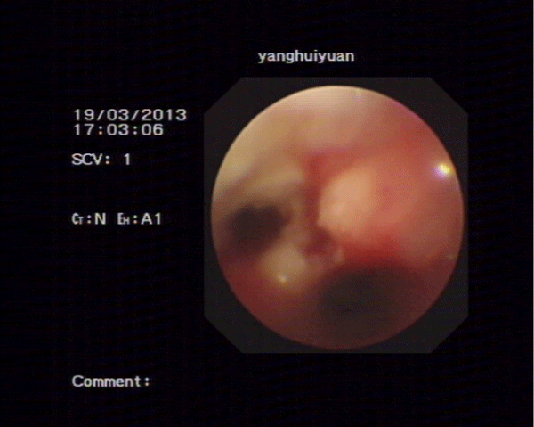 Bronchoscopic