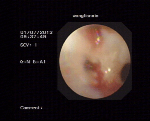 Bronchoscope