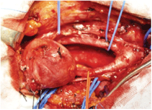 Resection