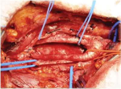 Carotid