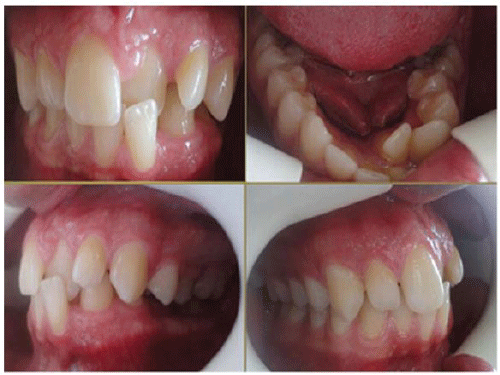 malocclusion
