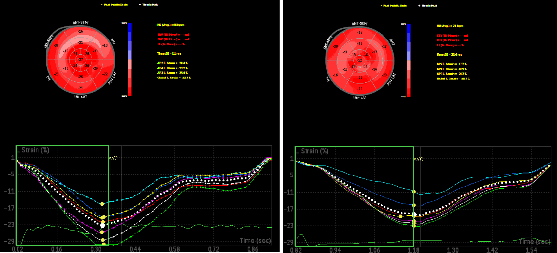 Global longitudinal strain (GLS)