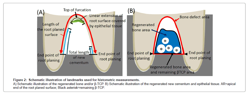 interradicular bone