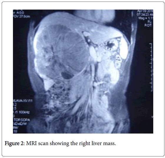 Biological-Medical-Sciences-MRI-scan-right-liver-mass