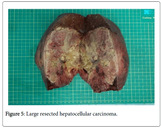 Biological-Medical-Sciences-hepatocellular-carcinoma