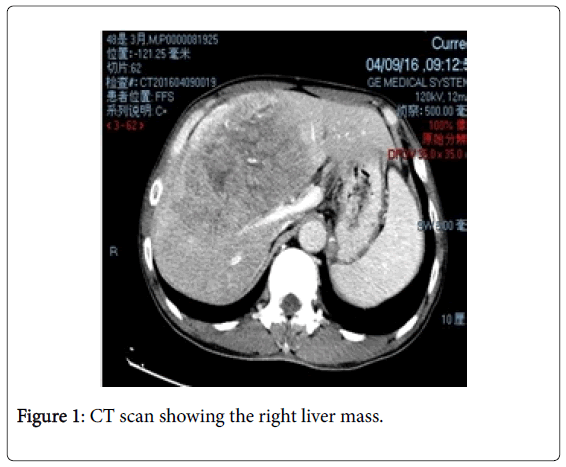 Biological-Medical-Sciences-right-liver-mass