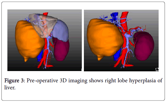 Biological-Medical-Sciences-right-lobe-hyperplasia