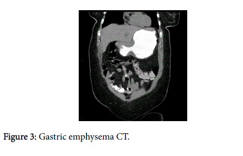 Digestive-System-Gastric-emphysema-CT