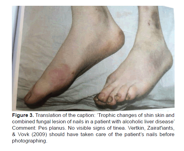 Emergency-Mental-Health-Translation-caption-Trophic-changes-shin-skin