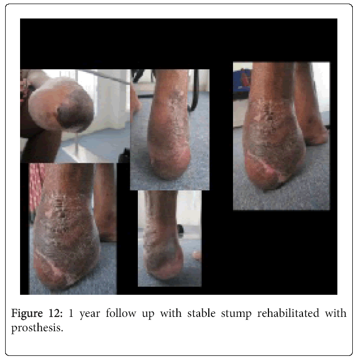 Foot-Ankle-1-year-follow-up-with-stable-stump-rehabilitated