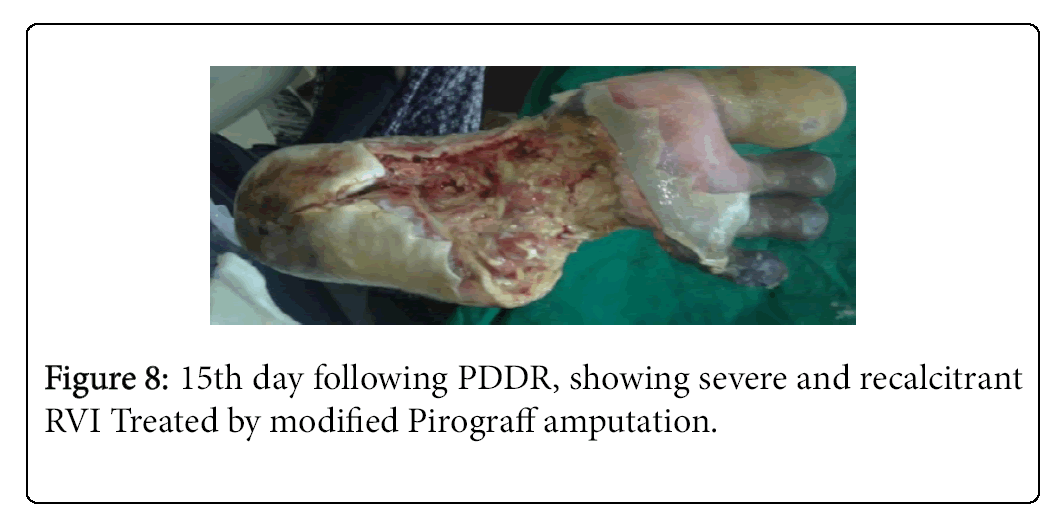 Foot-Ankle-15th-day-following-PDDR-showing-severe