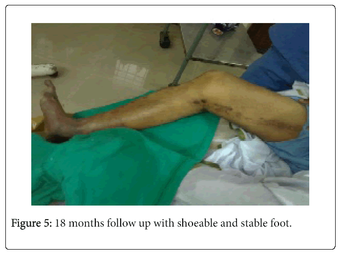 Foot-Ankle-18-months-follow-up-with-shoeable-and-stable-foot