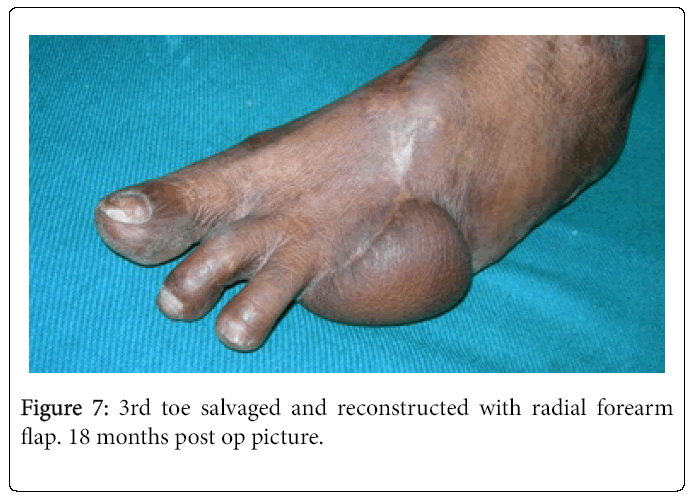 Foot-Ankle-3rd-toe-salvaged-and-reconstructed-with-radial-forearm
