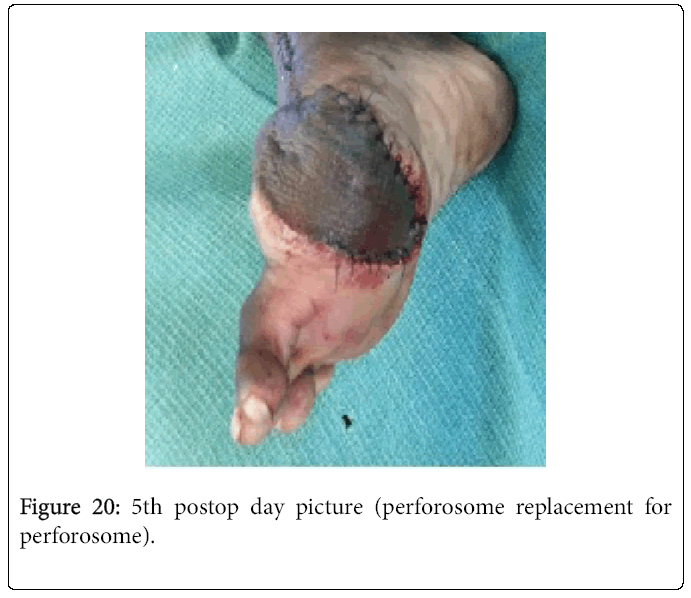 Foot-Ankle-5th-postop-day-picture-perforosome-replacement