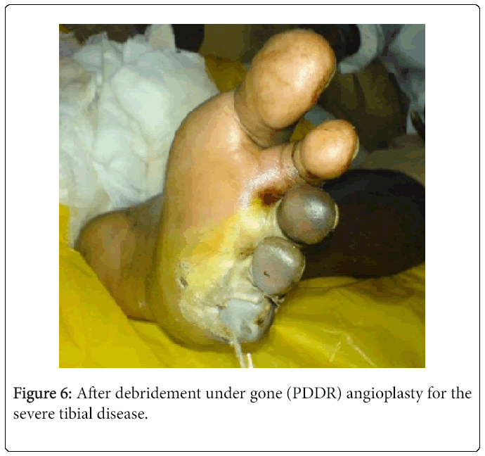 Foot-Ankle-After-debridement-under-gone-PDDR-angioplasty