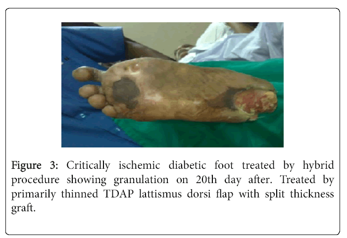 Foot-Ankle-Critically-ischemic-diabetic-foot-treated-hybrid