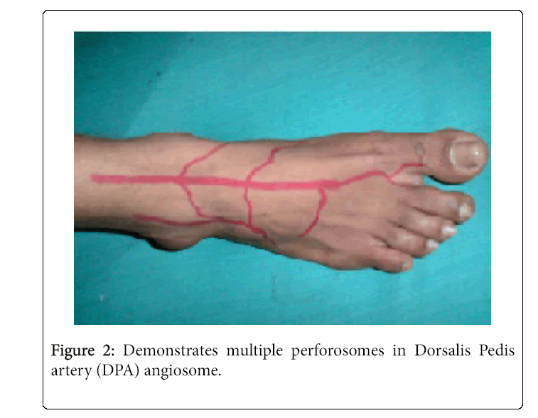 Foot-Ankle-Demonstrates-multiple-perforosomes-Dorsalis-Pedis