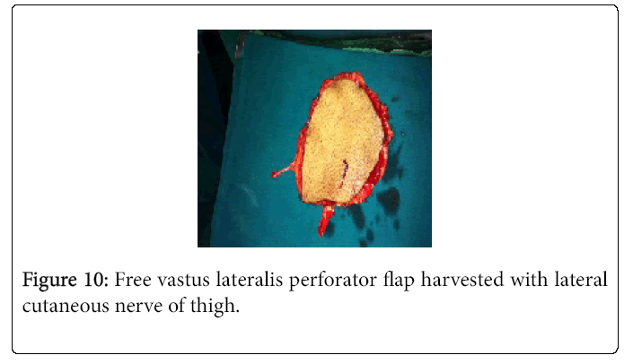 Foot-Ankle-Free-vastus-lateralis-perforator-flap-harvested