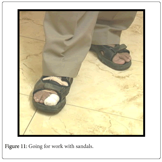 Foot-Ankle-Going-for-work-with-sandals