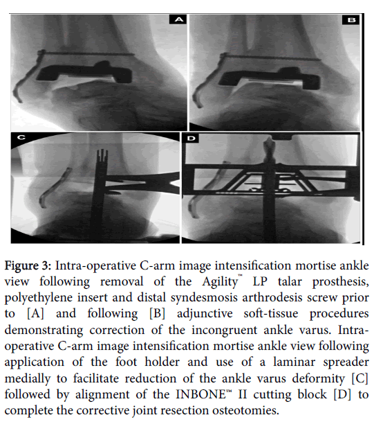 Foot-Ankle-Intra-operative-C-arm