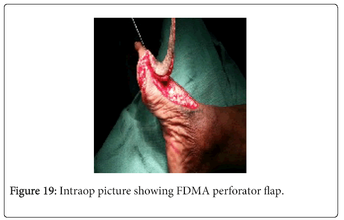 Foot-Ankle-Intraop-picture-showing-FDMA-perforator-flap