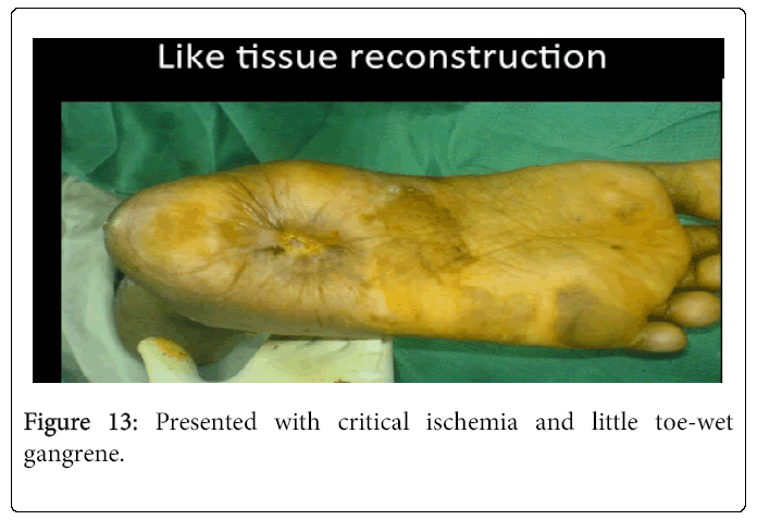 Foot-Ankle-Presented-with-critical-ischemia
