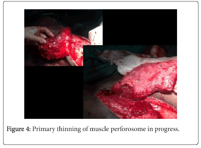Foot-Ankle-Primary-thinning-muscle-perforosome-progress