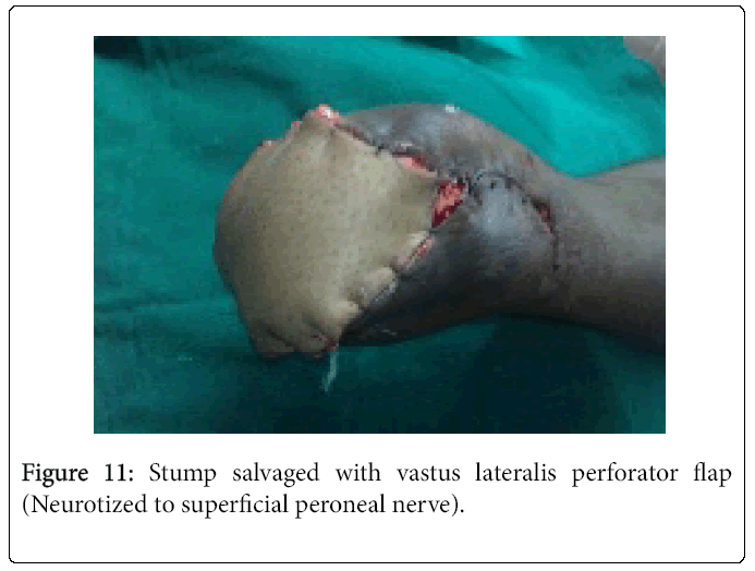 Foot-Ankle-Stump-salvaged-with-vastus-lateralis-perforator